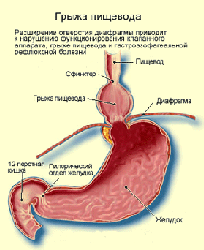 Грыжа пищевода — симптомы, лечение, осложнения, диета