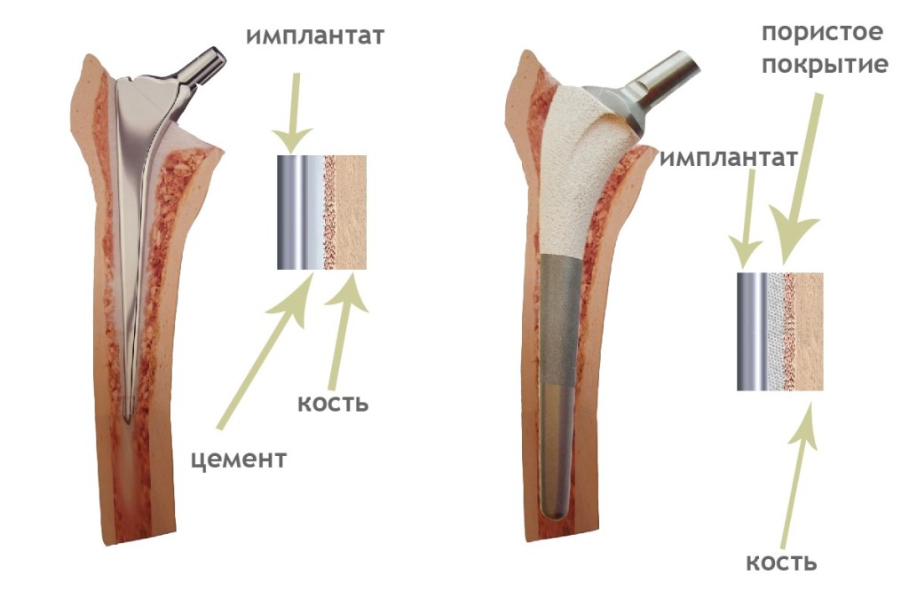 Типы протезов при эндопротезировании тазобедренного сустава