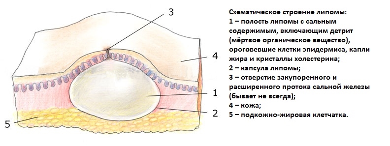 Жировик симптомы фото