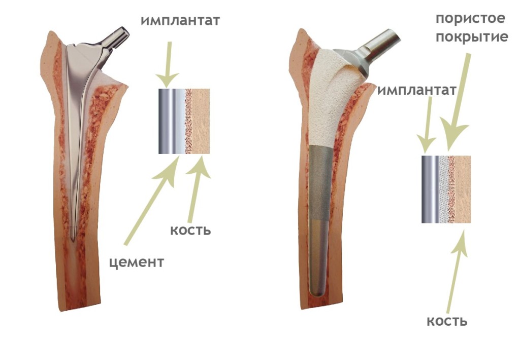 протезы коленного и тазобедренного сустава из чего