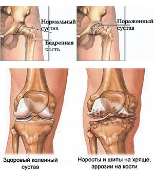 Лечение артроза тазобедренного сустава в минске thumbnail