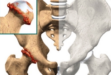 Коксартроз тазобедренного сустава лечение в минске thumbnail